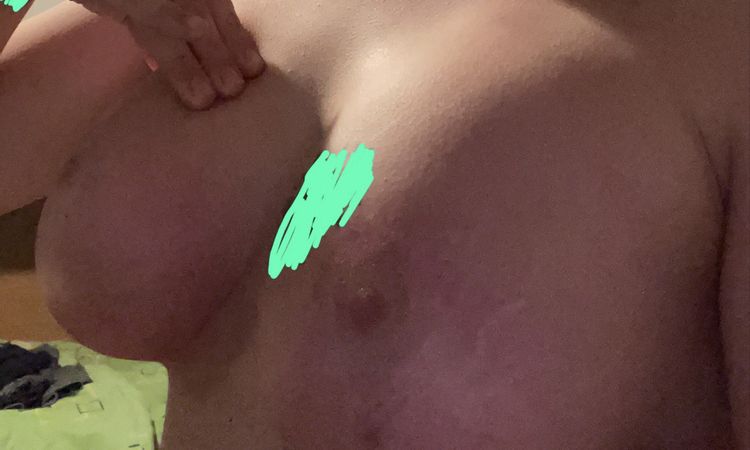 Mastopessi dopo 3 mesi, seno cadente? - 45289