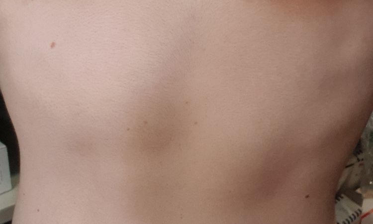 Fibrosi dopo ginecomastia, come la elimino? - 45294