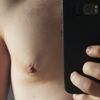 Fibrosi dopo ginecomastia, come la elimino?