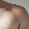 Fibrosi dopo ginecomastia, come la elimino?