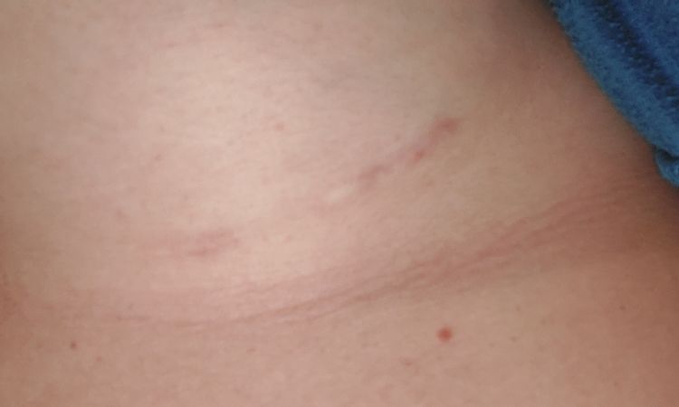Cicatrice cheloide dopo mastoplastica additiva? - 45372