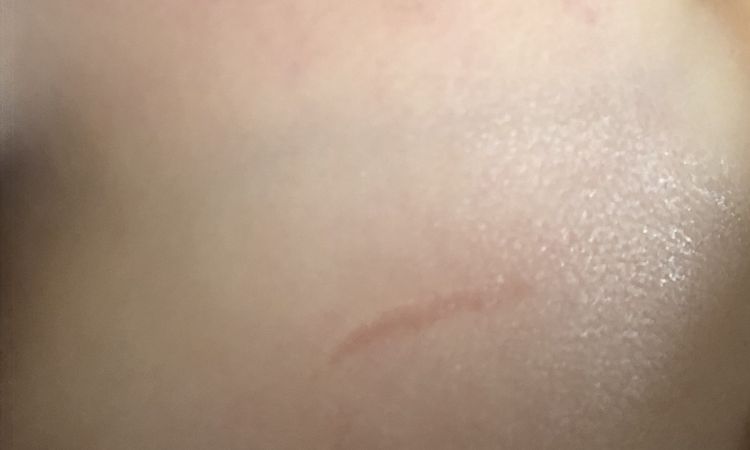 Solco derivante da graffio su viso bambino 16 mesi - 45446