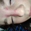 Cicatrice naso bimba - 45534
