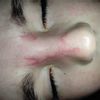 Cicatrice naso bimba - 45535
