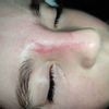 Cicatrice naso bimba - 45536