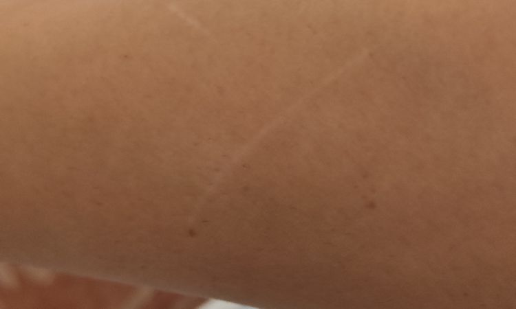 Posso tatuarmi su una cicatrice da graffio? - 45753