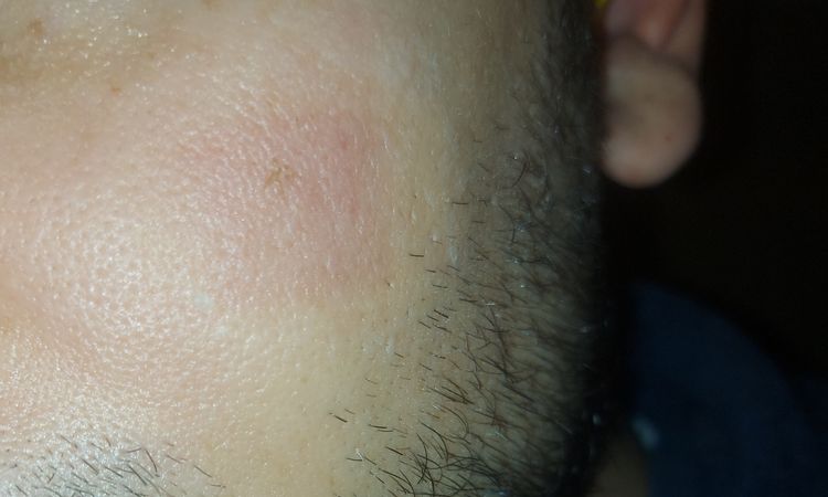 Eritema dopo laser co2 - 45773