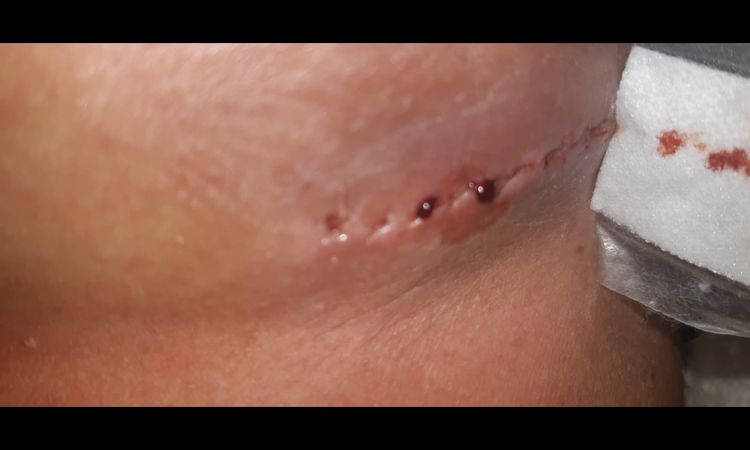 Sangue da cicatrice ematoma - 46615