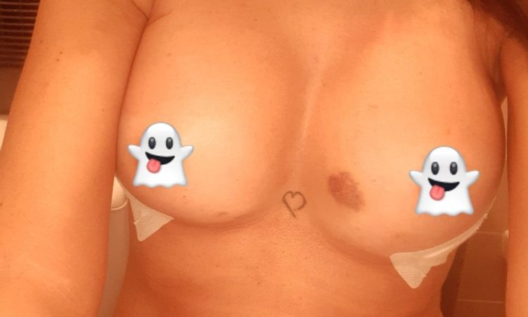 Sangue da cicatrice ematoma - 46616