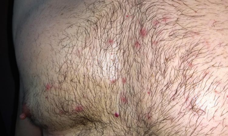 Follicolite resistente dopo un tatuaggio - 47138