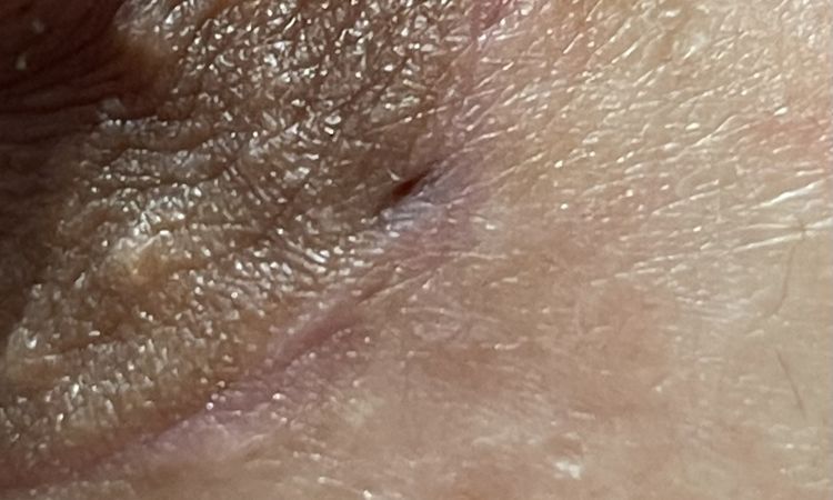 Cicatrice retraente post mastoplastica e infezione punto di sutura - 47139