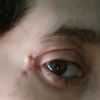 Cosa è accaduto ai muscoli e nervi oculari - 47411