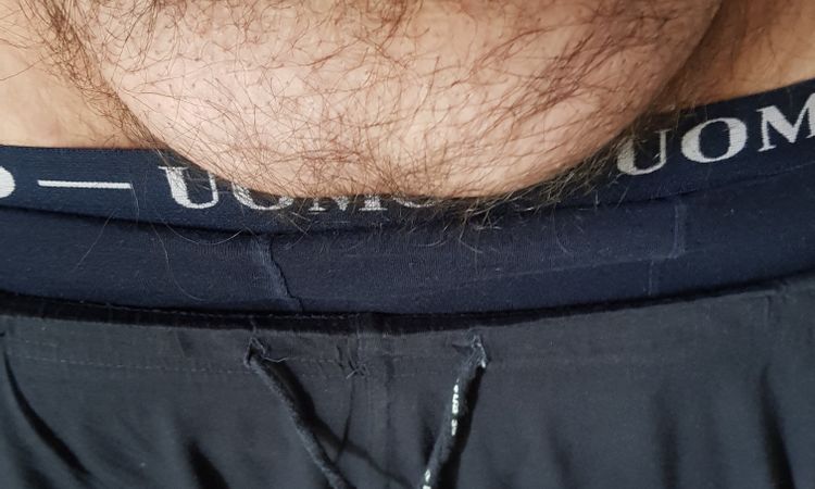 Liposuzione Pube grasso - 47420