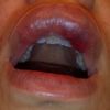 Occlusione vascolare filler labbra?