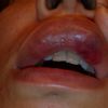 Occlusione vascolare filler labbra?