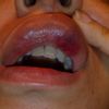 Occlusione vascolare filler labbra? - 47721