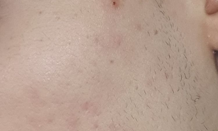 Laser co2 frazionato su fototipo leggermente scuro, rischi? - 48011