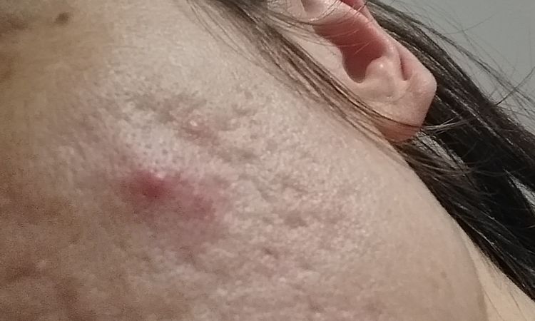 Consiglio per acne a 38 anni - 48128