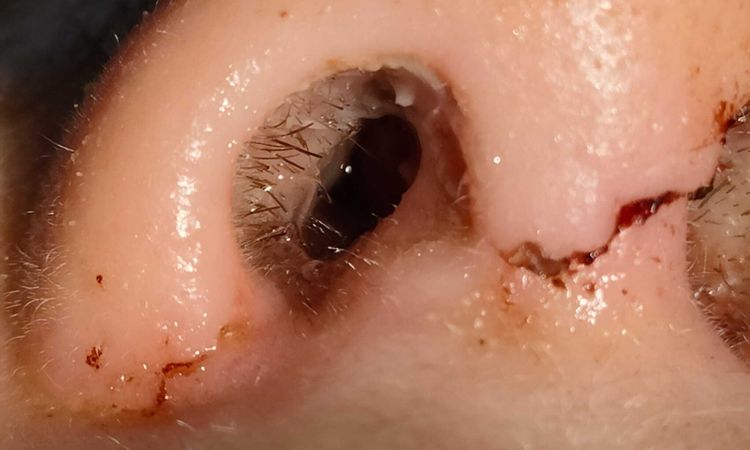 Sangue dal naso dopo rinoplastica - 48223