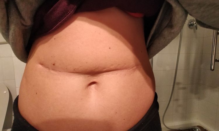 Possibilità di migliorare una cicatrice addome - 48288