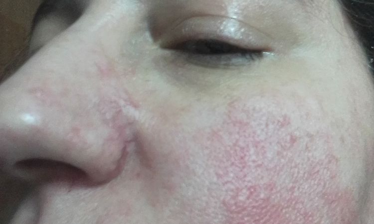 Ho un problema di rosacea che vorrei risolvere - 48336