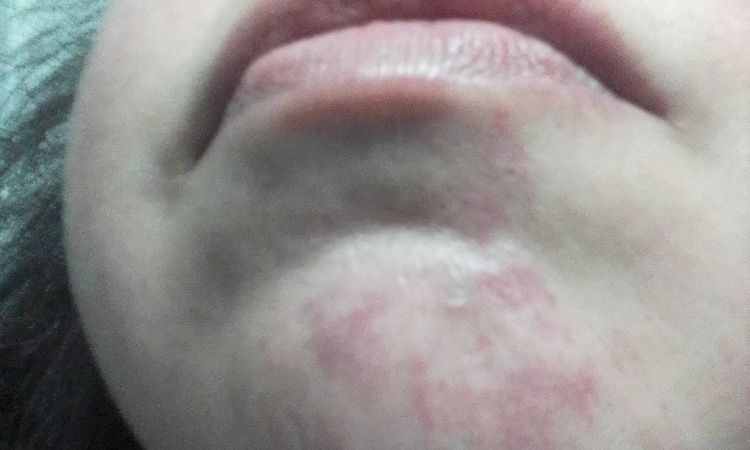 Ho un problema di rosacea che vorrei risolvere - 48337