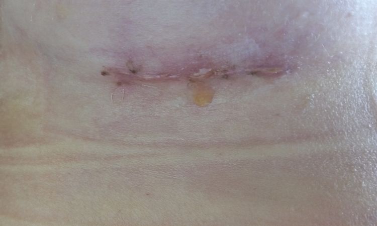 Espianto post mastoplastica - 48518