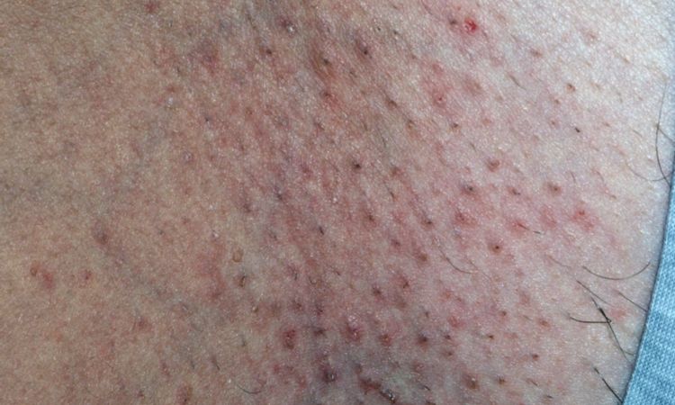 Epilazione laser da dermatologo - 48635