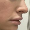 Un corretto uso del filler per labbra - 48830