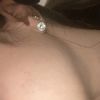 Lifting e cicatrici da acne