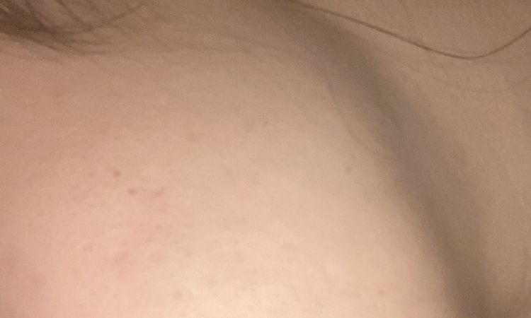 Lifting e cicatrici da acne - 49141