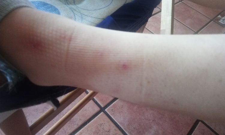 Macchie sulle gambe adolescente - 49201