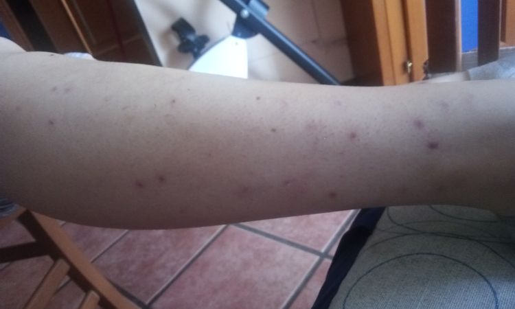 Macchie sulle gambe adolescente - 49202