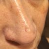 Solchi sul naso dopo due mesi da rinoplastica - 49211