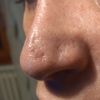 Solchi sul naso dopo due mesi da rinoplastica - 49212