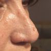 Solchi sul naso dopo due mesi da rinoplastica - 49213