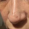 Solchi sul naso dopo due mesi da rinoplastica - 49214
