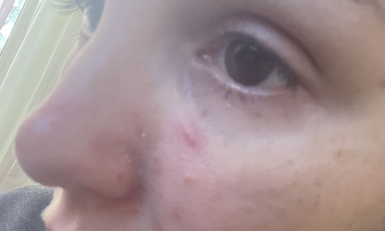 Laser viso post operazione - 49671