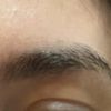 Migrazione filler acido ialuronico