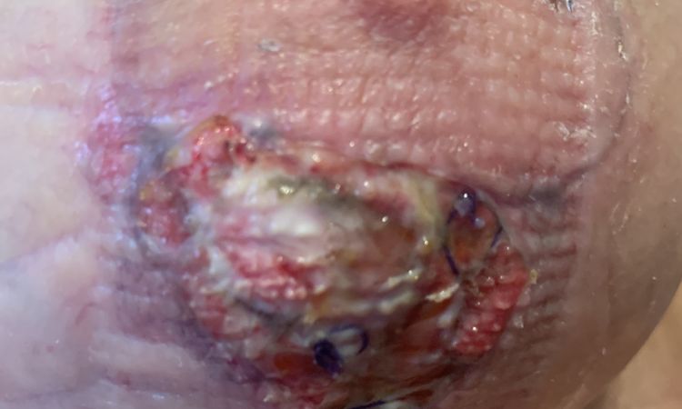 Infezione cicatrice mastopessi - 50952