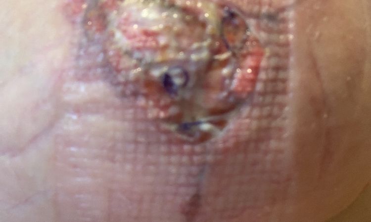 Infezione cicatrice mastopessi - 50953
