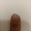 Amputazione carne sopra l'unghia del dito - 51143