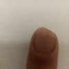Amputazione carne sopra l'unghia del dito - 51144