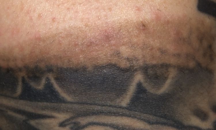 Post laser qswitched tatuaggio - 51273
