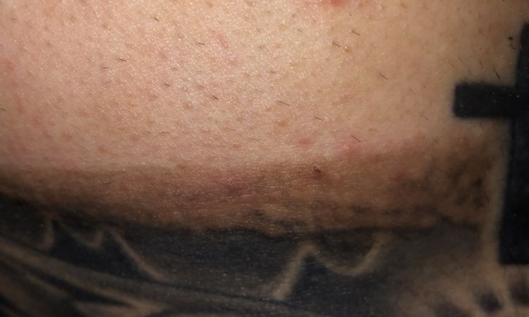 Post laser qswitched tatuaggio - 51274