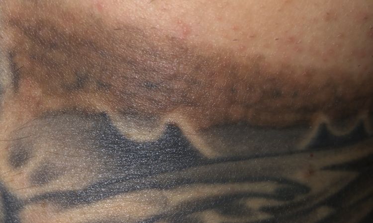 Post laser qswitched tatuaggio - 51276