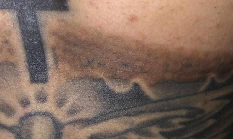 Post laser qswitched tatuaggio - 51277