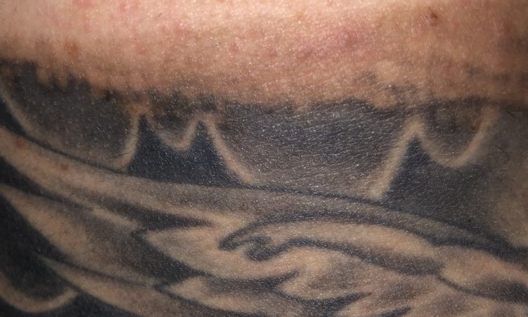 Post laser qswitched tatuaggio - 51278