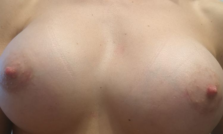 Seno gonfio e deforme dopo 2 mesi dalla mastoplastica - 51451