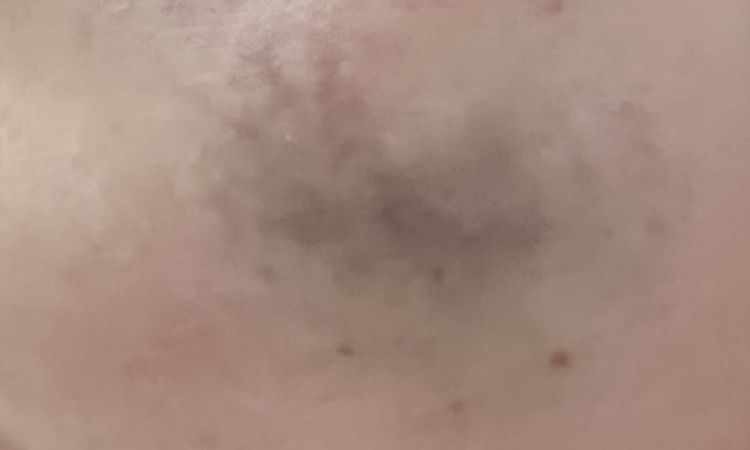 Occlusione vascolare filler - 51507